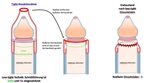 Beschneidung - UROclinic Bogenhausen